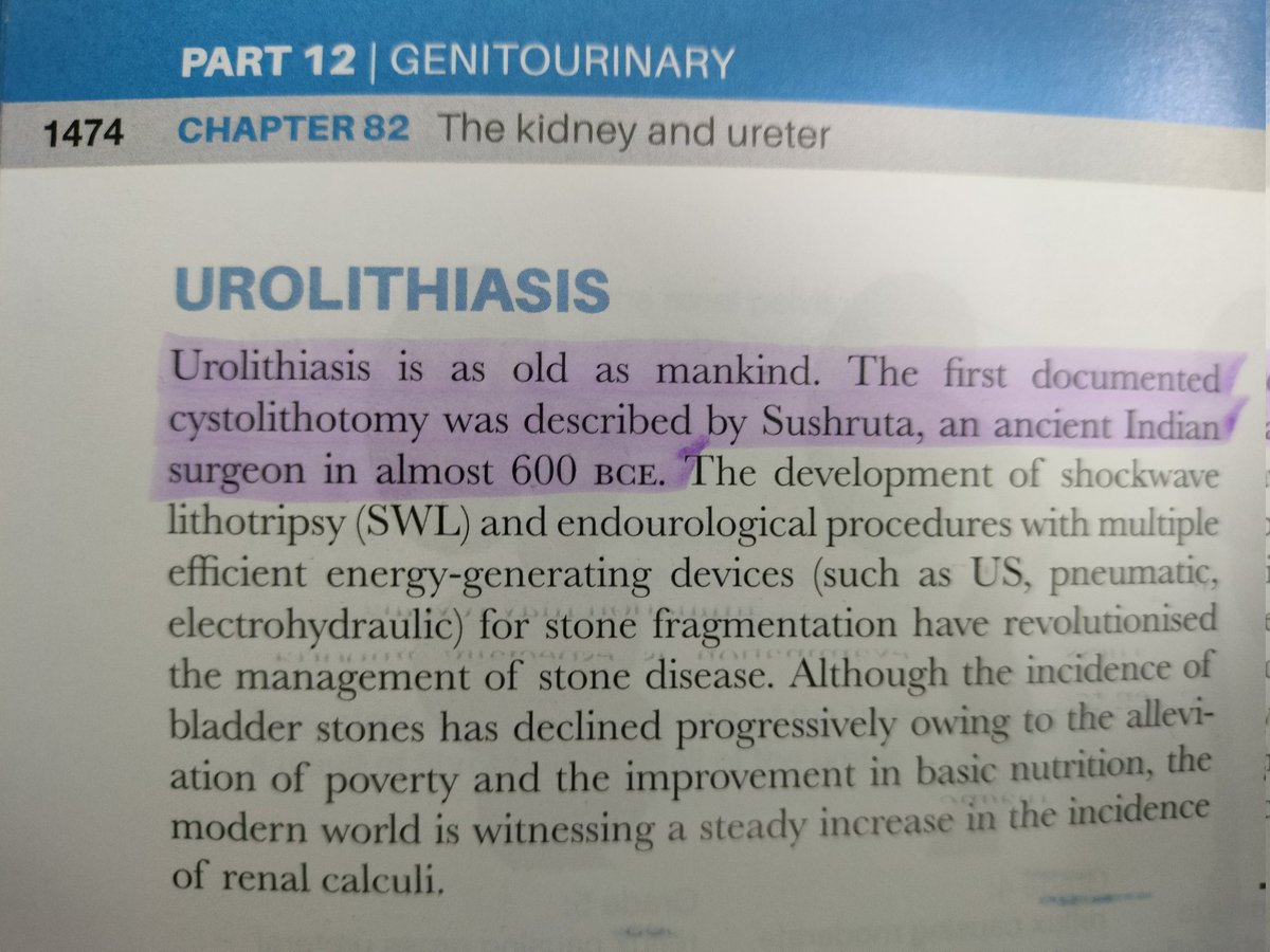 Renal Stones/Urolithiasis is as old a mankind!
Book: Bailey and Love's Short Practice of Surgery 
#MedicalHistory #RenalStones #Surgery #HistoryOfMedicine