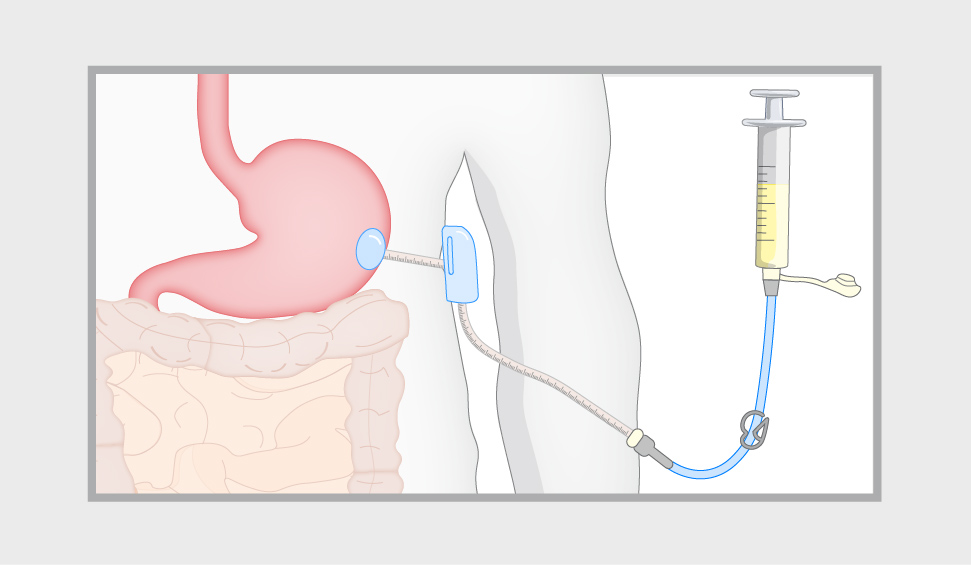 Enteral nutrition via gastrostomy is a relatively common practice, but it comes with important considerations such as patient selection, timing, & insertion method. Gain patient care insights via our 'Mistakes in gastrostomy insertion' article. Access now: bit.ly/49v5vxA