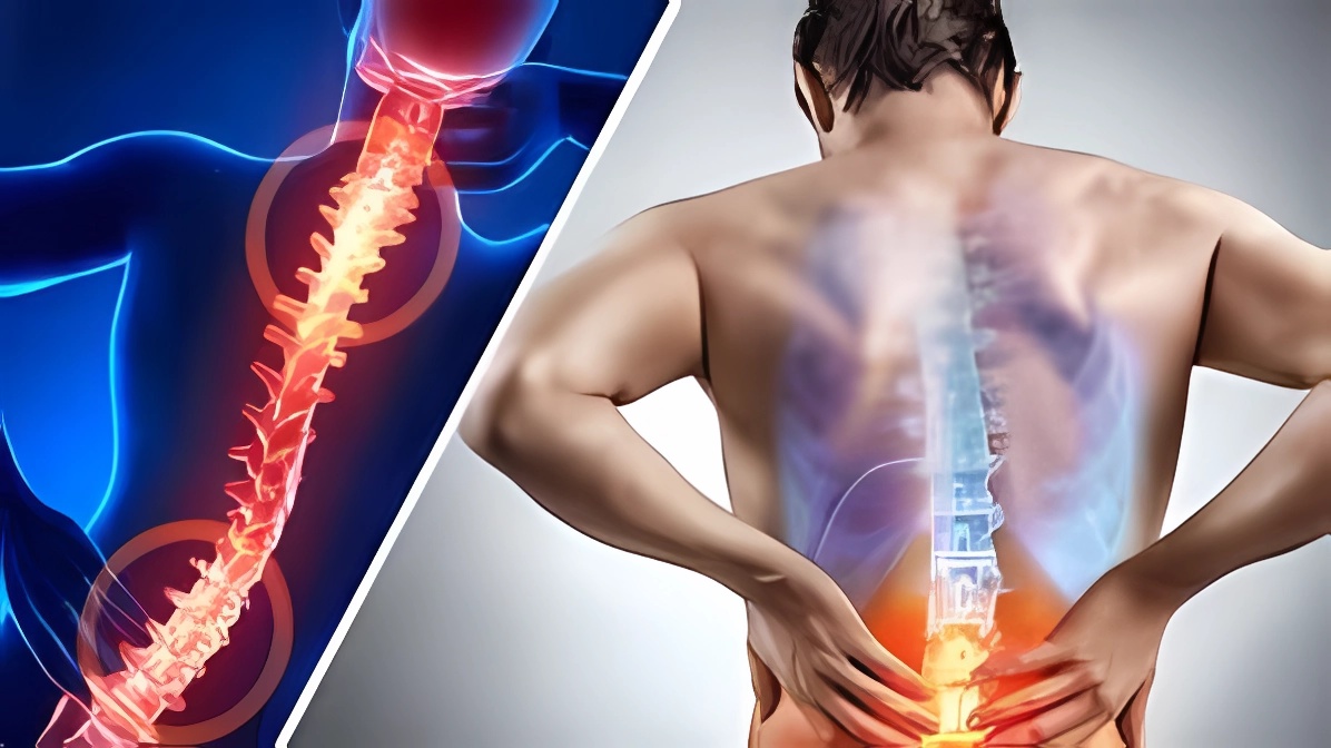 #spinalstenosis: Everything you need to know:
A condition that causes compression of the nerves in the #spine

#ResearchPapers 
Learn more @ 2ly.link/1wyJv
#spineconference #spinalcord #SpinalDisorders #spinalcordinjury #spinalhealth #Neurosurgery  #spinesurgery