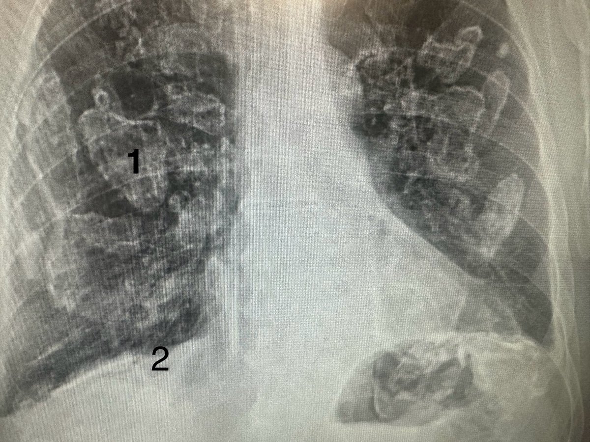 Asbestosis thoracic disease 1. Pleural plaques (after 20y of exposure, holly-leaf, asx, Ca2+) 2. Diaphragmatic pleural plaques are pathognomonic. 3. Pleural effusion 4. Diffuse pleural thickening 5. Malignant mesothelioma