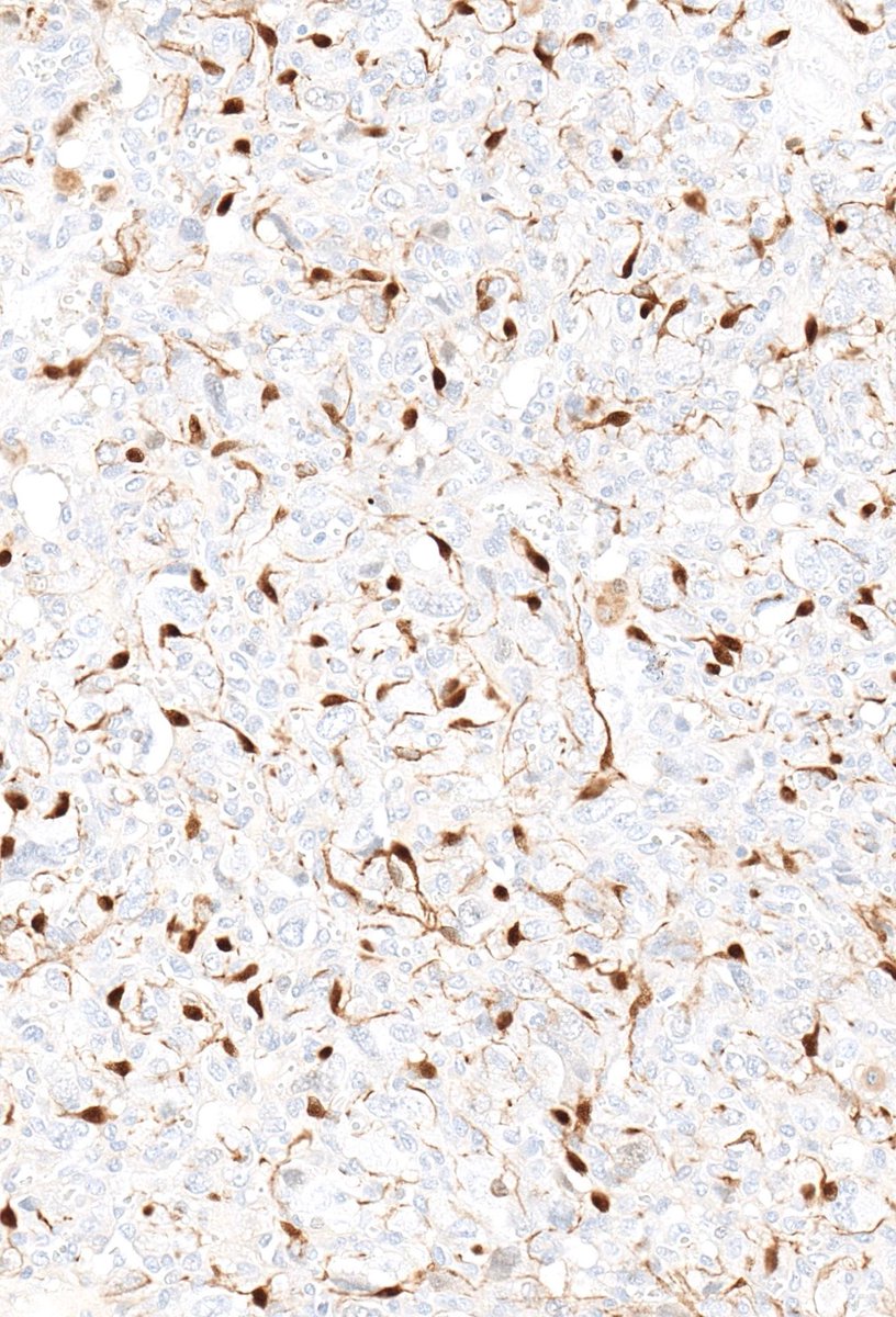 A Classic! What stain is this? What are these cells called? Diagnosis? More IHC: kikoxp.com/posts/17495 Answer & digital slides 🔬✅ kikoxp.com/posts/17494 Video ⏯️ kikoxp.com/posts/15033 #BSTpath #pathologists #pathology #pathTwitter #ENTpath