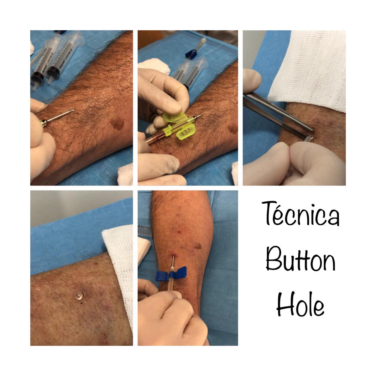 NefroCHUO's tweet photo. Primeros pacientes de hemodiálisis domiciliaria con buttonhole en @NefroCHUO #nuevosretos #hemodialisisdomiciliaria #HDD #fístula #dyalisis #buttonhole https://t.co/EIwjNYSuQB