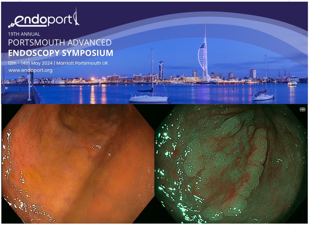 Endo_Port (@endo_port) on Twitter photo ⁉️ Did you see this subtle lesion in a patient with UC?
we have a whole session on advances in management of neoplasia in IBD
Find out more at #ENDOPORT2024 endoport.org
Discount code "ENDOESGE30"
<a href="/drkeithsiau/">Keith Siau</a> <a href="/ESGE_news/">ESGE</a> <a href="/BritSocGastro/">BSG</a> <a href="/BSGTrainees/">BSG Trainees</a> <a href="/helpatologist/">Nadeem Tehami</a> ⁉️ Did you see this subtle lesion in a patient with UC?
we have a whole session on advances in management of neoplasia in IBD
Find out more at #ENDOPORT2024 endoport.org
Discount code "ENDOESGE30"
<a href="/drkeithsiau/">Keith Siau</a> <a href="/ESGE_news/">ESGE</a> <a href="/BritSocGastro/">BSG</a> <a href="/BSGTrainees/">BSG Trainees</a> <a href="/helpatologist/">Nadeem Tehami</a>