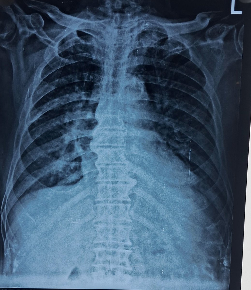Interpret CXR
60Male HTN, sudden onset dyspnea with sweating
@anujtiwari11 @DrAkhilRaghavan @DrRanjit_4_u @DrShauryaGarg @cardiodoc1988 @Rajatpsoge @radiologistpage @Radiopaedia #MedTwitter #radiology #imaging 
#chestxray