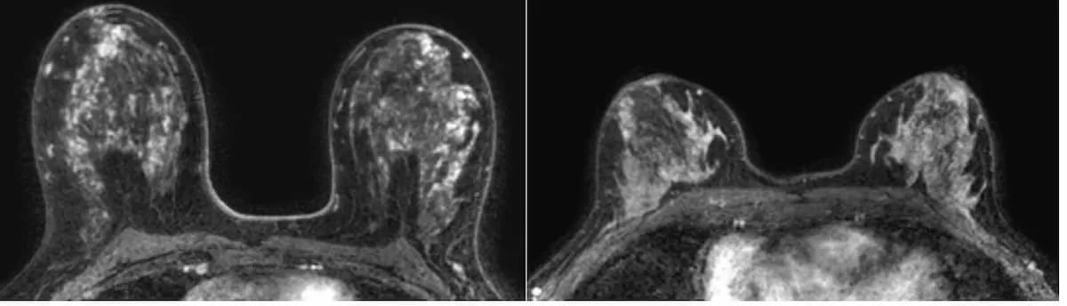 Can #AI Automate BPE Assessment of #DenseBreasts on #MRI? diagnosticimaging.com/view/can-ai-au… @ACRRFS @ACRYPS @RadiologyACR @ARRS_Radiology @RSNA @DenseBreastInfo @SBIRFS @YaleRadiology @UNCRadiology @OchsnerRads @BURadiology @EmoryRadiology @UVARadiology @WCMRadiology #radiology #RadRes