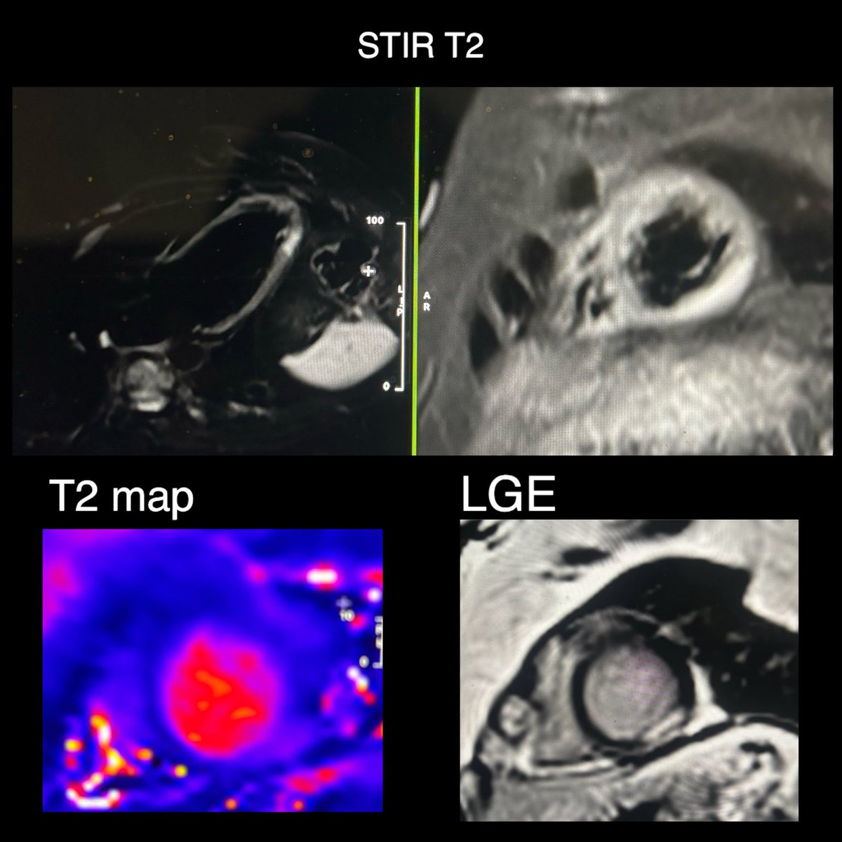 32yo 👩🏻
#whyCMR #CardioTwitter
myocarditis