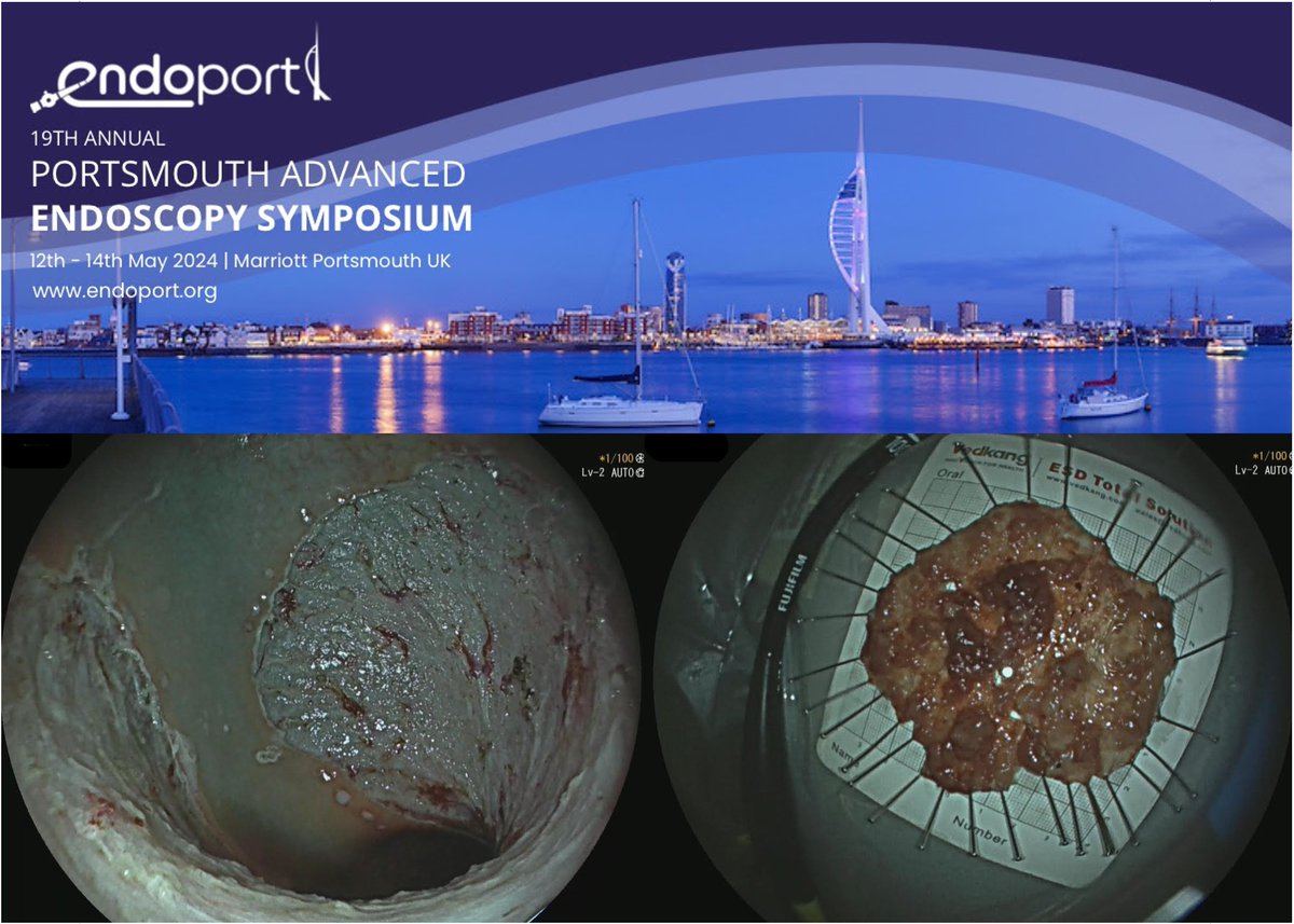 📢Big polyp debt EMR vs ESD Technical tips for improving EMR and ESD techniques and hands-on session Check the programme and register at eventbrite.co.uk/e/portsmouth-a… Discount Code 'ENDOESGE30' @MarkSdoc1 @Noor_Endo @NorikoSuzuki3 @DrBuHayee @BritSocGastro @BSGTrainees @ESGE_news