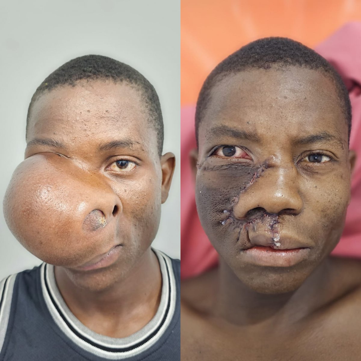 bnzobo's tweet photo. Madaktari Bingwa Kinywa na Meno (Uso na Mataya) wenye kufanya huu upasuaji wapo Tanzania (Rufaa Kanda Mbeya, Bungando, Dodoma RRH, Benjamin Mkapa, Singida RRH, BOMBO-Tanga  KCMC, Muhimbili-Upanga &amp; Mloganzila). Ukiona uvimbe eneo la Kinywa na Meo wahi Hospitali (consent signed) https://t.co/cz1ZAVYqq4