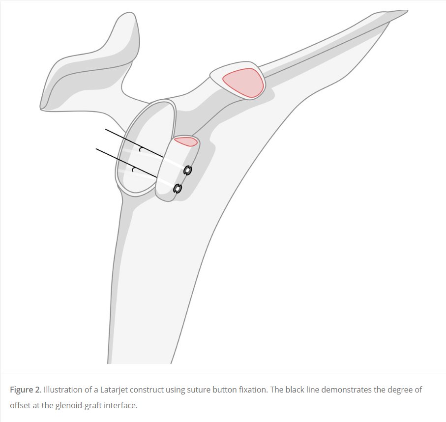 Screw or button for glenoid augmentation? This systematic review from @UAlabama shows buttons offers comparable strength without screw related complications. #shoulderdislocation #shoulderinstability #Bankart #Latarjet Read it #OpenAccess here! ow.ly/9HMB50RaQVI