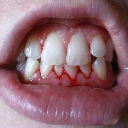 Do your gums bleed like this when you brush your teeth and floss? I guarantee your body is inflamed. I'll explain why & what to do to reverse it.