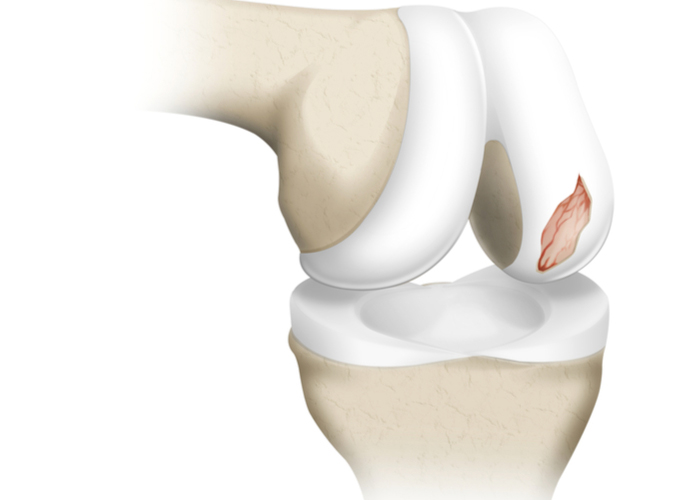 Repairing damaged cartilage is now simpler with particulate juvenile #articularcartilage repair. Find out how this procedure works and its advantages for patients with chondral defects. medilink.us/ddjx #cartilagerepair #orthotwitter