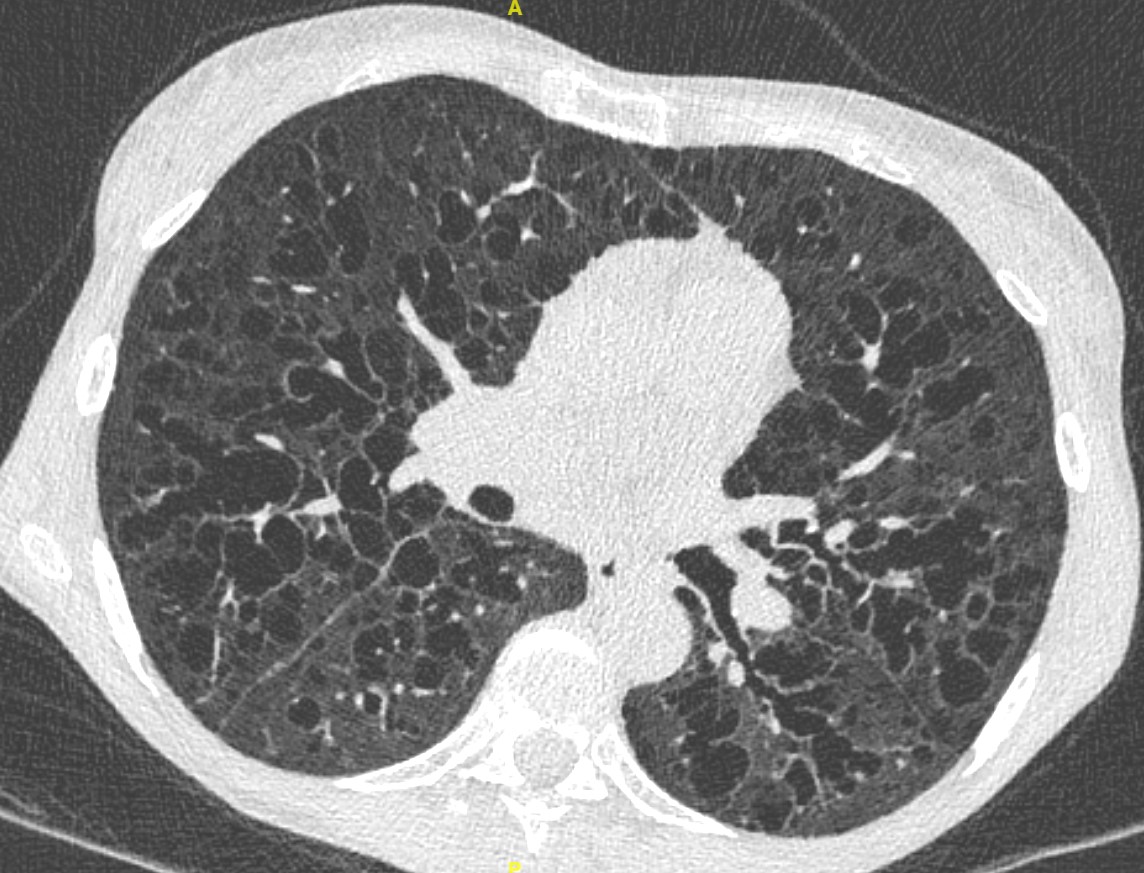 Have you heard about non-amyloid light chain deposition disease in the lung ? A rare form of cystic/bronchiectatic lung disease. See the study by the OrphaLung network
rdcu.be/dEpjk