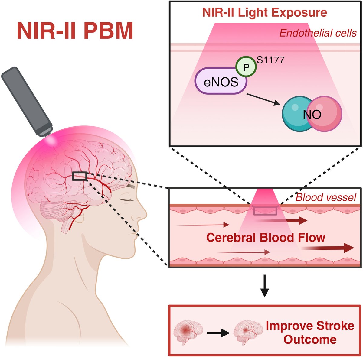 #STROKE: Transcranial photobiomodulation with low-power 1064 nm near-infrared laser improves stroke outcomes via eNOS phosphorylation in a mouse model, offering potential adjunctive therapy for stroke injury. #AHAJournals ahajournals.org/doi/10.1161/ST… @SKashiwagiMDPhD