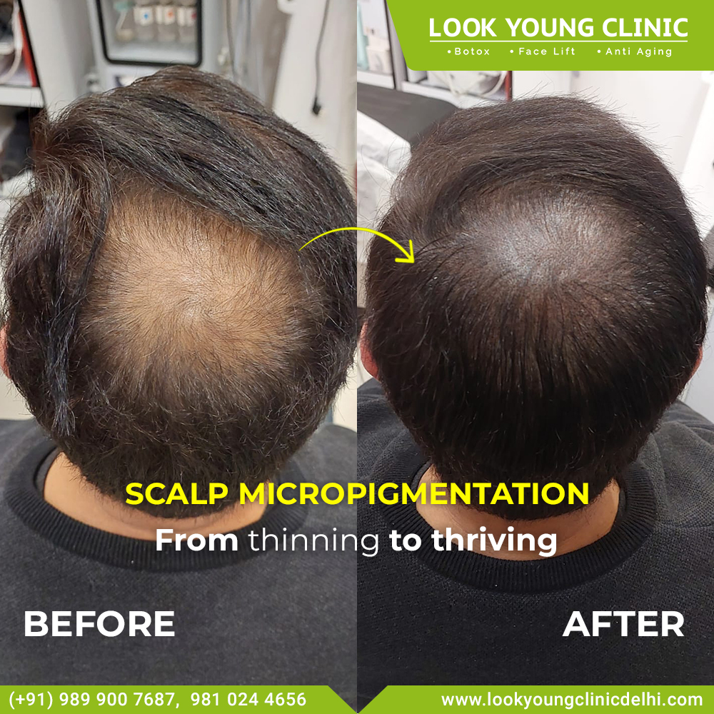 Transform your confidence from scalp to soul with scalp micropigmentation! Witness the incredible before and after results that redefine your hairline and redefine your look✨
.
.
.
#LookYoungClinic #ScalpTransformation #HairlineRestoration #SMPResults #HairLossSolution