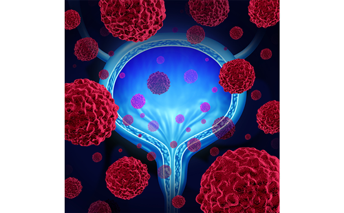 Advancements in Non-metastatic, Muscle-invasive Bladder Cancer: Delve into Ongoing Studies Investigating Novel Approaches to Bladder Preservation. Register now to continue reading: touchoncology.com/your-free-10-m… #BladderCancer #MedicalResearch #CancerTreatment
