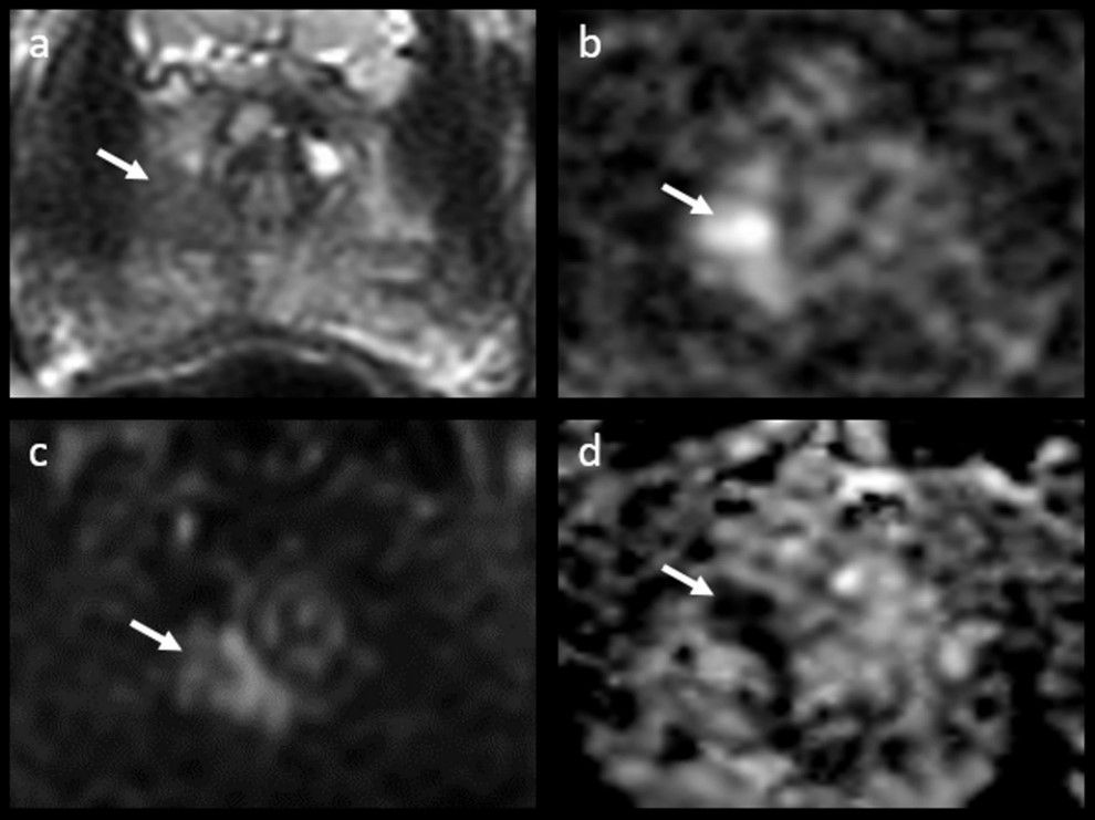 European Radiology (@eurradiology) on Twitter photo In this study, <a href="/StanzioneMD/">Arnaldo Stanzione</a> et al. highlight the importance of optimal prostate #MRI image quality to help guide management decisions regarding #ProstateCancer.
#EuropeanRadiology
🔗 buff.ly/3VNysl0 In this study, <a href="/StanzioneMD/">Arnaldo Stanzione</a> et al. highlight the importance of optimal prostate #MRI image quality to help guide management decisions regarding #ProstateCancer.
#EuropeanRadiology
🔗 buff.ly/3VNysl0