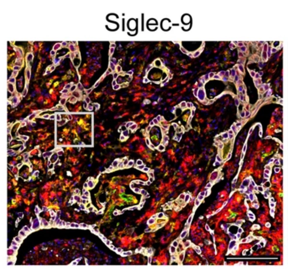 #PancreaticCancer-associated fibroblasts modulate macrophage differentiation via sialic acid-Siglec interactions nature.com/articles/s4200…