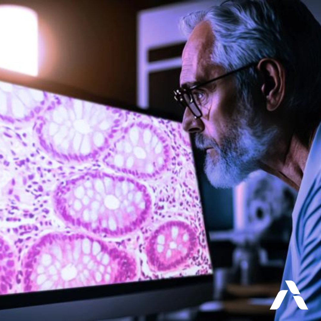 ArteraAI's biomarker test uses a unique algorithm to analyze thousands of biopsy images & patient data. Handling large images is challenging. Partnering with @union_ai, we're tackling tasks beyond conventional methods to bring personalized cancer therapy: bit.ly/3U2nYNb