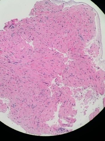 FNB of a large leiomyoma! #gitwitter #medtwitter #pathology