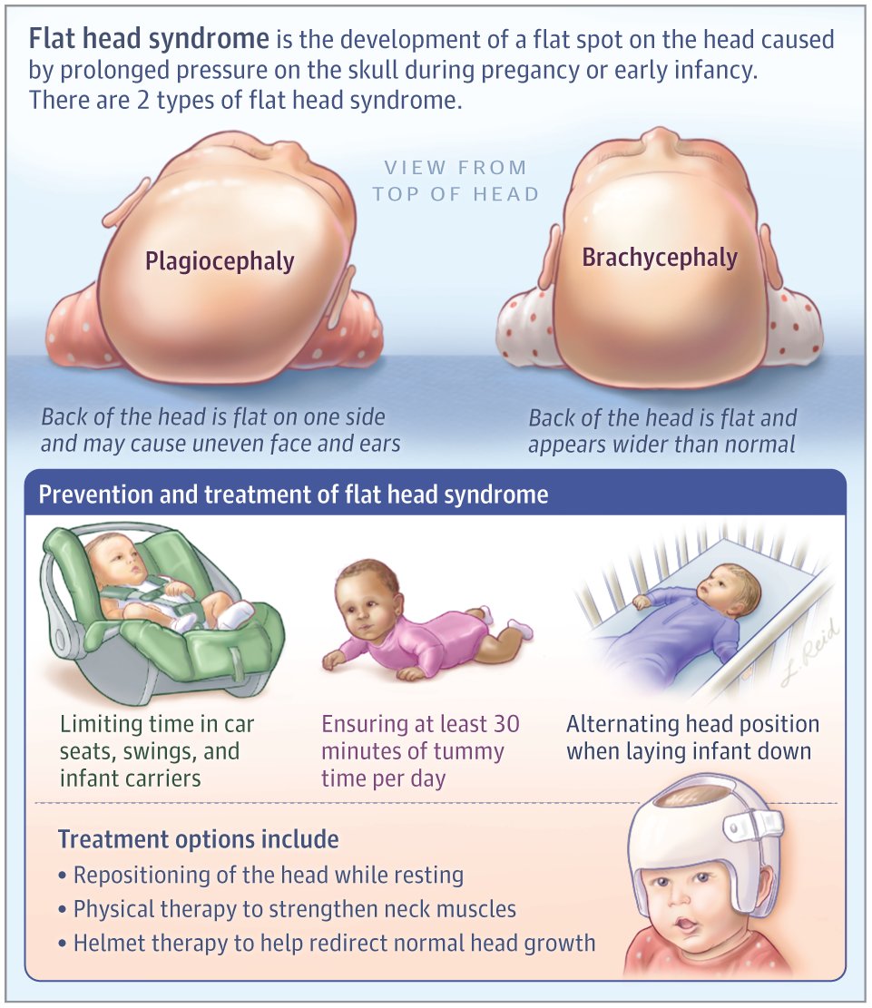 JAMA (@jama_current) on Twitter photo Flat head syndrome is caused by prolonged pressure on an infant’s skull during pregnancy or early infancy. 
This JAMA Patient Page describes the types, prevention, and treatment of flat head syndrome in infants. ja.ma/49s6myU Flat head syndrome is caused by prolonged pressure on an infant’s skull during pregnancy or early infancy. 
This JAMA Patient Page describes the types, prevention, and treatment of flat head syndrome in infants. ja.ma/49s6myU