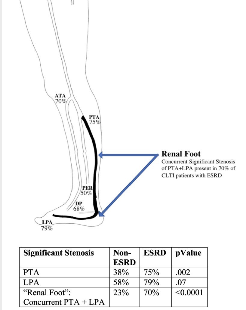 These are the two key angiographic characteristics associated with the 'renal foot' #DiabeticFoot #ActAgainstAmputation @KeckMedUSC  bit.ly/2r6awNk