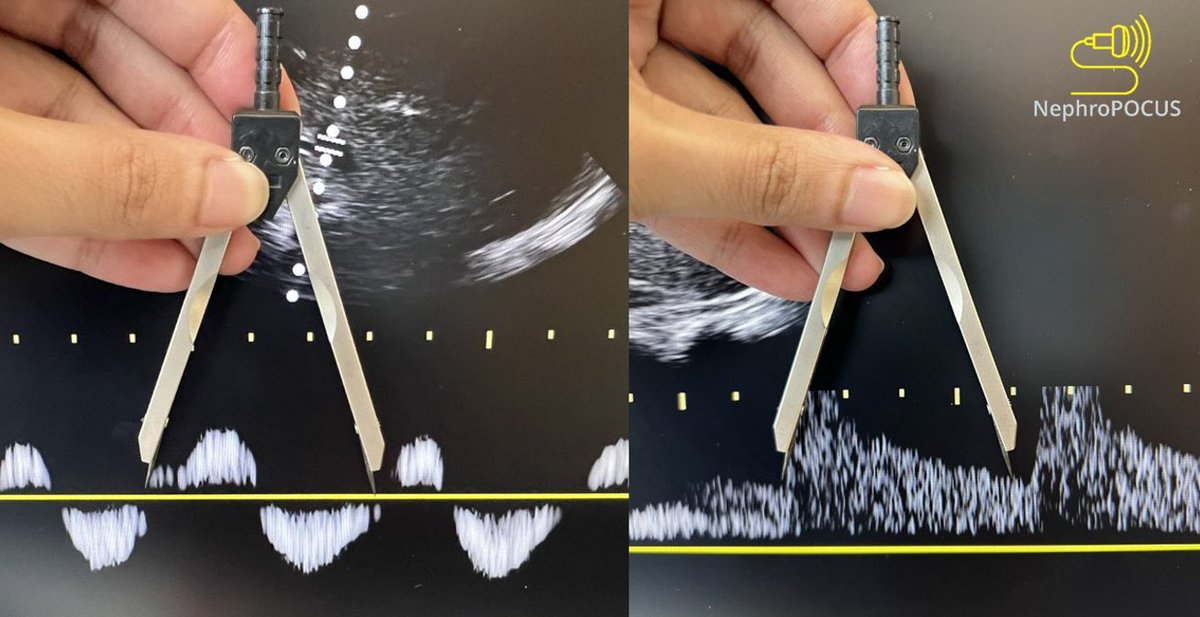 NephroPOCUS tweet media