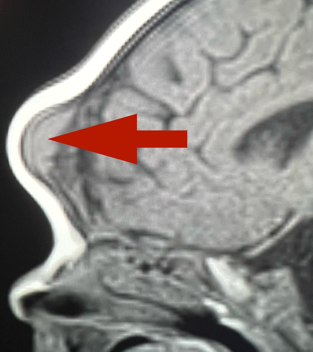 Tip of the day 💡: If the lesion is only remodelling the bone and is T1 short consider MNTI- melanocytic neuroectodermal tumor of infancy.