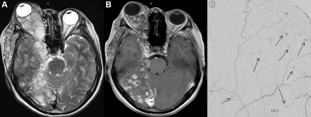 MRI scan shows a mass with high signal intensity involving the right orbit, middle cranial fossa, and subcutaneous tissue, while carotid DSA demonstrates heterogeneous enhancement of the lesion. bit.ly/3PXmVM9