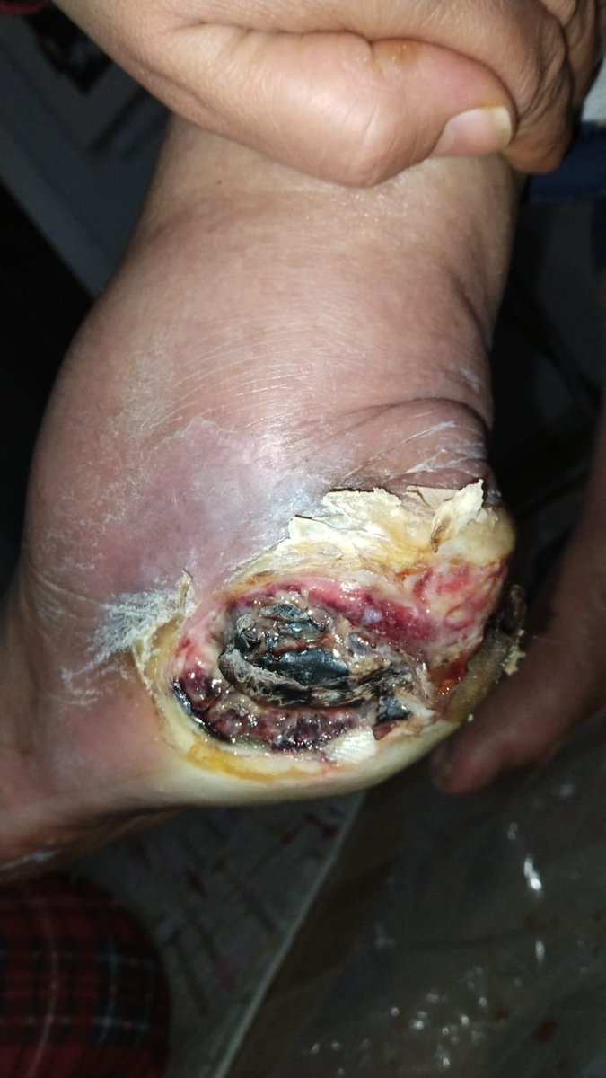 İstanbul’da yaşayan 75 yaşında imoş arslan teyzemiz 1 ayda rahatsızlanıp vücudu iltihap kaptı. Hastaneler yatış yapmıyor. Teyzemizin ağrıları çok fazla bize yardımcı olun lütfen . İletişim 0541 335 05 93
<a href="/drfahrettinkoca/">Dr. Fahrettin Koca</a> <a href="/saglikbakanligi/">T.C. Sağlık Bakanlığı</a>