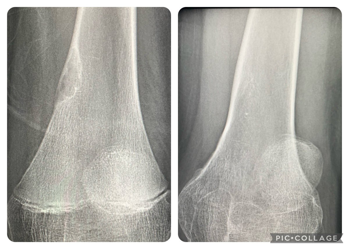 ‘Healing’ or involution of fibroxanthoma (non-ossifying fibroma) over 16 years