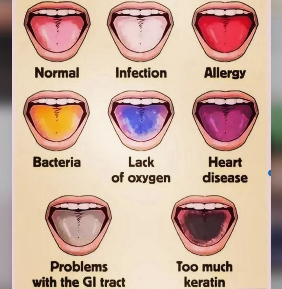 Tongue 👅 colour 
#MedTwitter #neetpg #MedEd