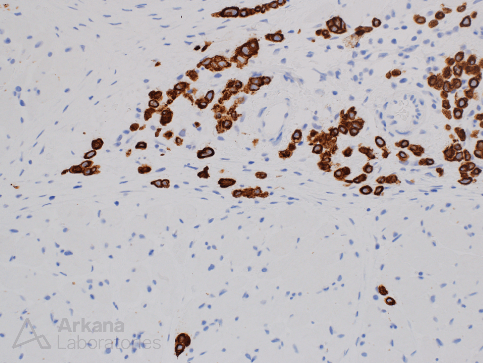 Clinical History: This 50-year-old patient presented with muscle weakness and stiffness. They had recently been identified to have diffuse thickening of the stomach wall. #NeuroNotes