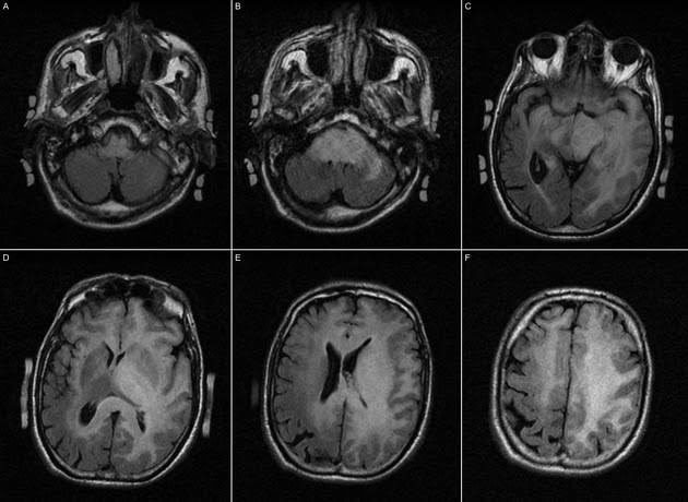 ⚠️ SPOILER ALERT for K-drama fans ⚠️ In #QueenOfTears, Hae-in's fictional 'cloud cell tumor/'cloud cytoma' most closely resembles gliomatosis cerebri. 🔗 radiopaedia.org/cases/gliomato…