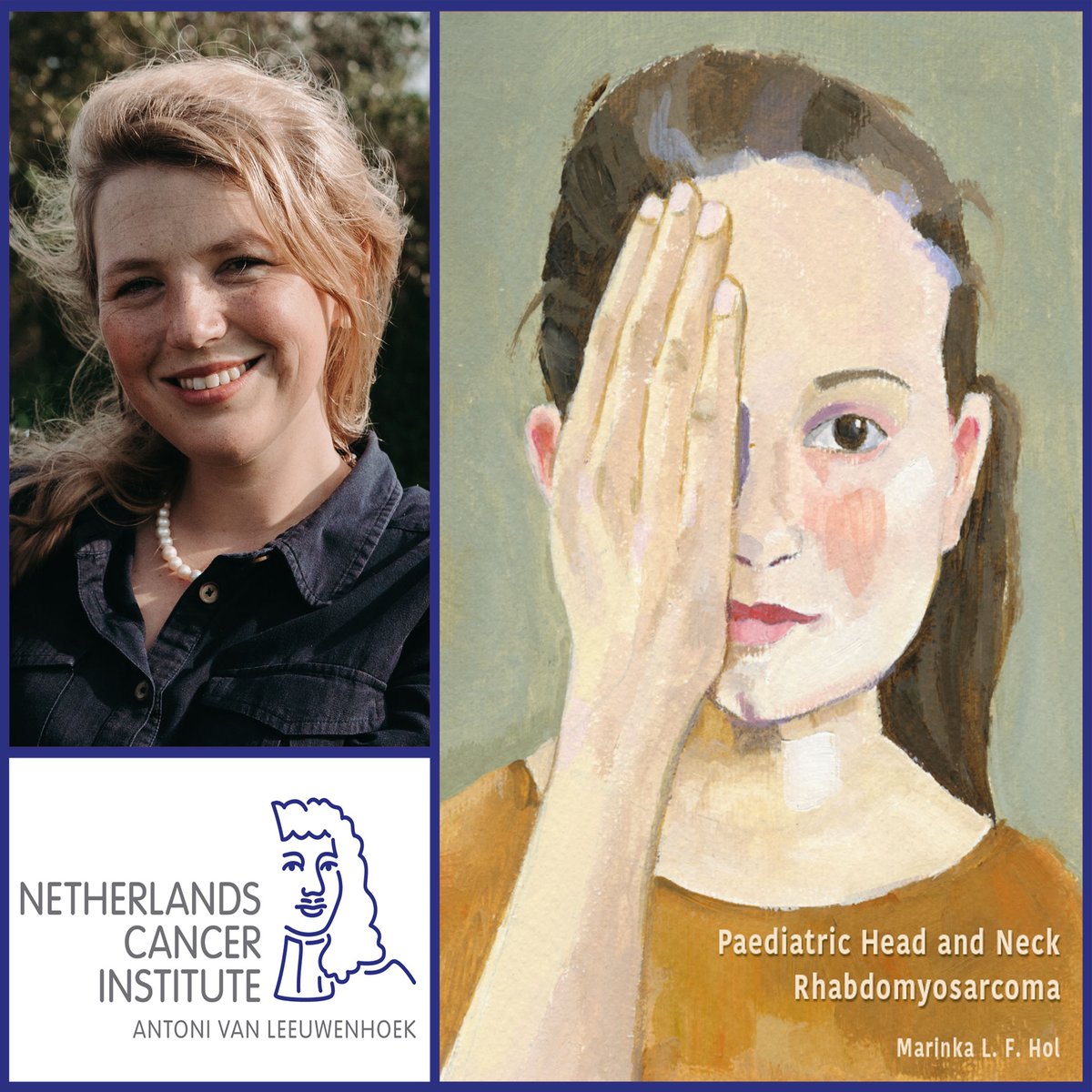 In four international centers, PhD. candidate Marinka Hol investigated facial abnormalities and other late effects of tumors in children. Marinka will defend her thesis on April 12 ➡️ bit.ly/3TS7UN2 @hetAVL @UvA_Amsterdam @prinsesmaximac