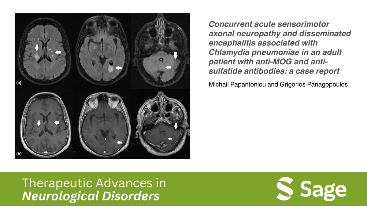 Unveiling a complex neurological presentation: Explore the intriguing case of concurrent acute sensorimotor axonal neuropathy and disseminated encephalitis associated with Chlamydia pneumoniae infection. Read more: journals.sagepub.com/doi/full/10.11… #Neuroscience #CaseStudy 📚🔬