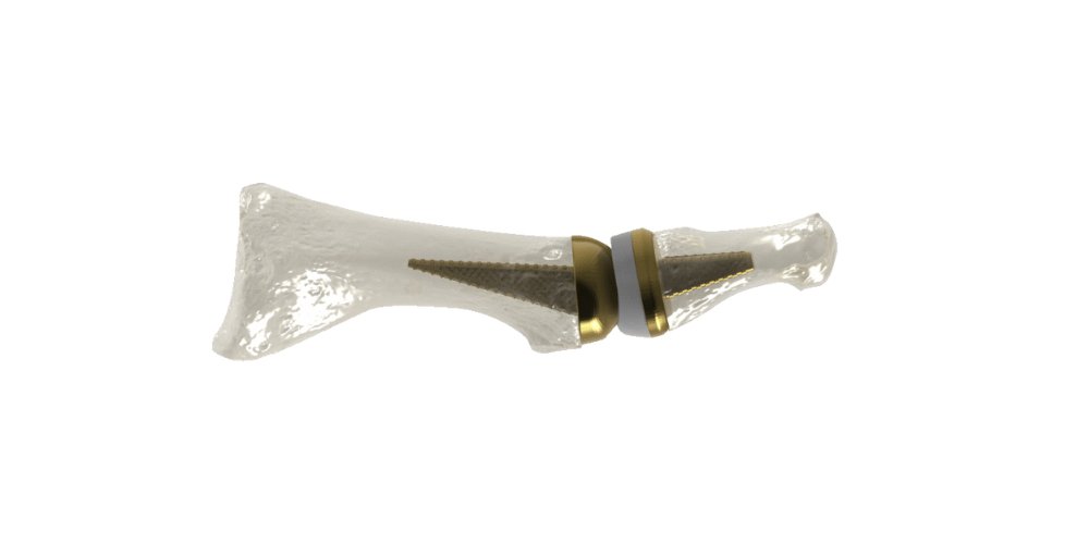 Young #medtech company Anatomic Implants pioneers high-tech solutions for toe joints using #AdditiveManufacturing. Read more about their groundbreaking MTP joint replacement, manufactured with precision from titanium in collaboration with AddUp: formnext.mesago.com/frankfurt/en/t… #Formnext