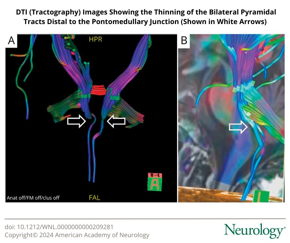 Teaching NeuroImage: Vertebrobasilar Dolichoectasia Presenting as Spastic Paraparesis bit.ly/43VVOXx #NeurologyRF #NeuroTwitter