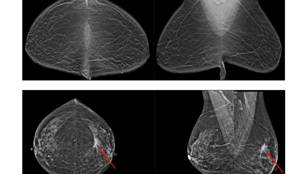 Using AI to supplement radiologists’ evaluation of mammograms may improve breast-cancer screening, according to a study by @WUSTLmed researchers at Siteman Cancer Center and colleagues at @WhiteRabbitAI. siteman.wustl.edu/ai-mammogram-m…