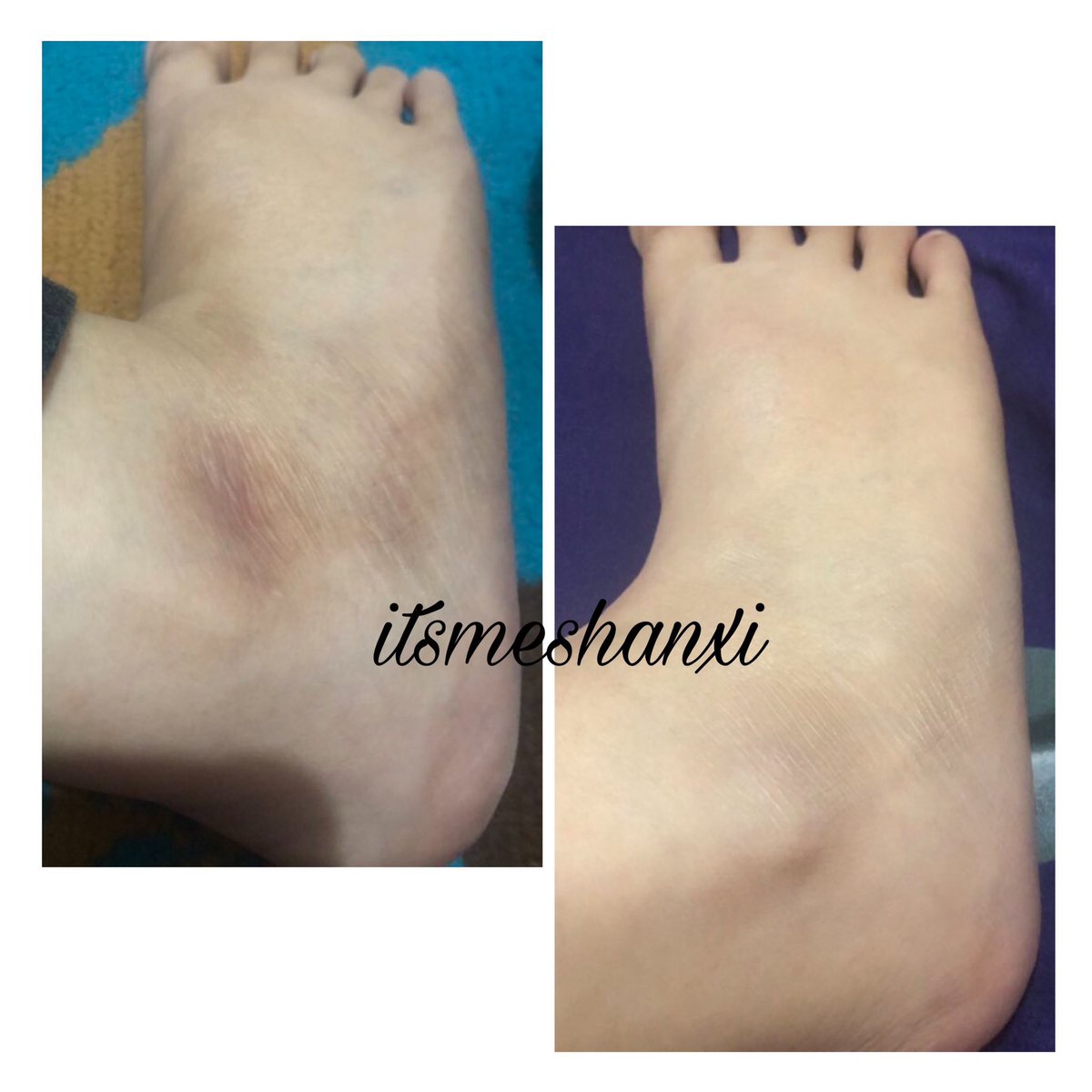 pweetynxi's tweet image. Area lipatan care, aku rajin scrub aja pake Purbasari yg butiran halus jadi aman buat lipatan👌

Terus pake axillary cream ini aku udah pake setahun lebih ampuh buat mencerahkan &amp;amp; menghaluskan tekstur kulit🥺🫶 Mana wangi. 

Even dokter saranin ini juga👌