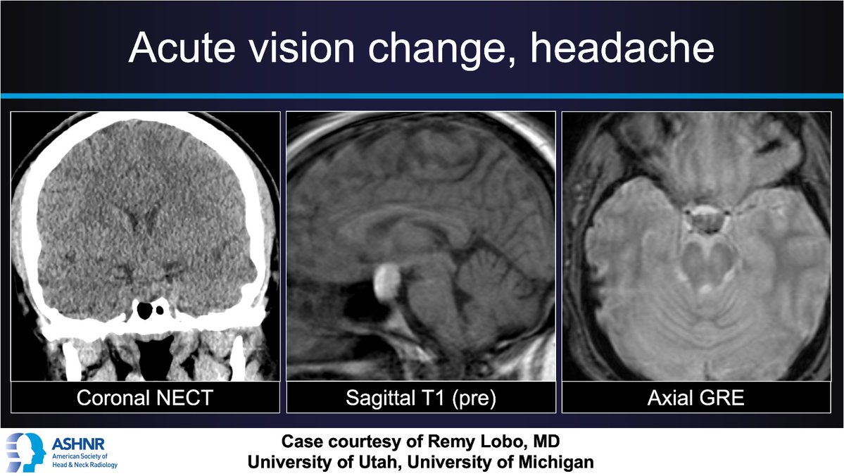 #ASHNRCOTW #248 Vision change + HA. Thx @remyrlobo 4 case! #ASHNR24 Answer w/ appropriate GIF only -- stay professional & don't spoil it! @callyrobs @DShatzkes @CDP_Rad @nakoontz @rhwiggins @KRileyMD @CMGlastonbury @cmtomblinson @tabby_kennedy @PhilipRChapman1 @CynXinWu