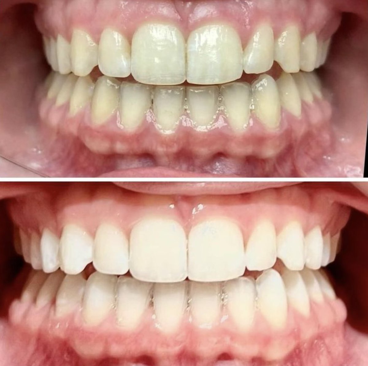 #KoRWhitening is so good, even dentists recommend it to family members! Dr. Medianick in Reading, PA, had his daughter use KöR Whitening, and she's thrilled with the results! 😁🌟 

#SmileTransformation #TeethWhiteningSucess #TeethWhitening