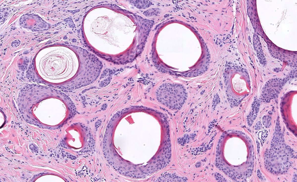 Skin nodule. A rare & beautiful dermpath zebra! Diagnosis? Answer: kikoxp.com/posts/25508 Video: kikoxp.com/posts/11337 #pathology #pathologists #pathTwitter #dermpath #dermatology #dermatologia #dermtwitter