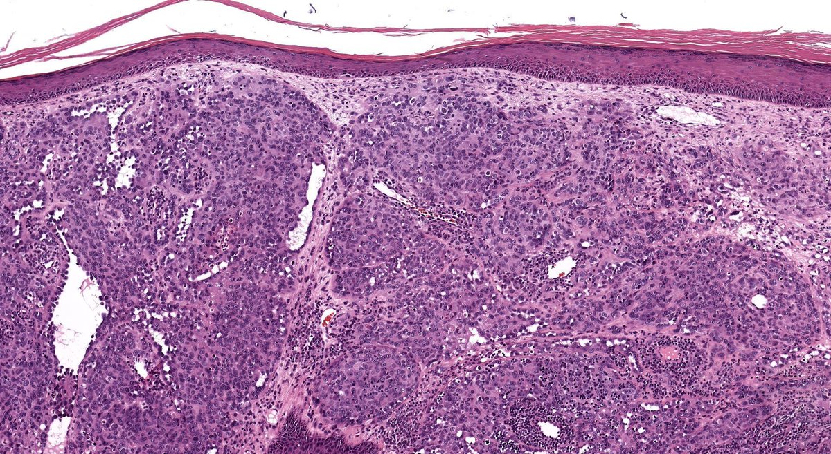 80 M pink papule nose. Can you make the diagnosis from one pic, or is it #TooCloseToDiagnose? Digital slides & IHC: kikoxp.com/posts/21794 Answer: kikoxp.com/posts/21505 #pathology #pathologists #pathTwitter #dermpath #dermatology #dermtwitter