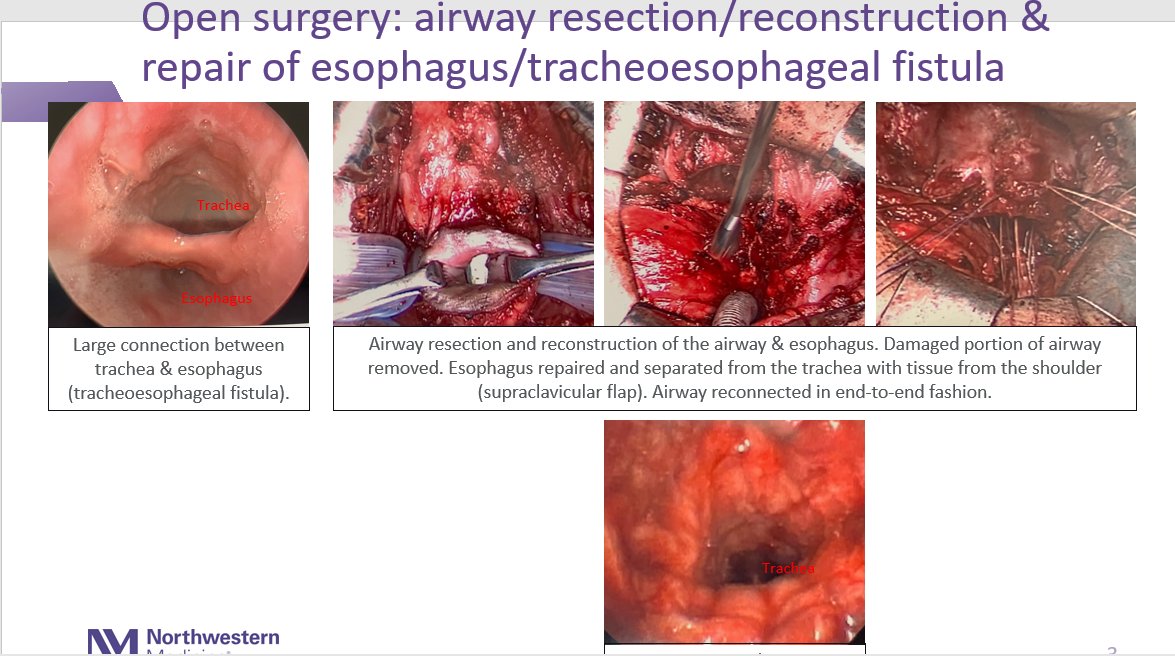 NM_ENT's tweet photo. The Northwestern Medicine #ComplexAirways team of pulmonologists, thoracic surgeons and otolaryngologists worked to #reconstruct a patient's airway and a very complex #fistula to the food pipe. #MultidisciplinaryTeam https://t.co/sgnLjRG7Ga