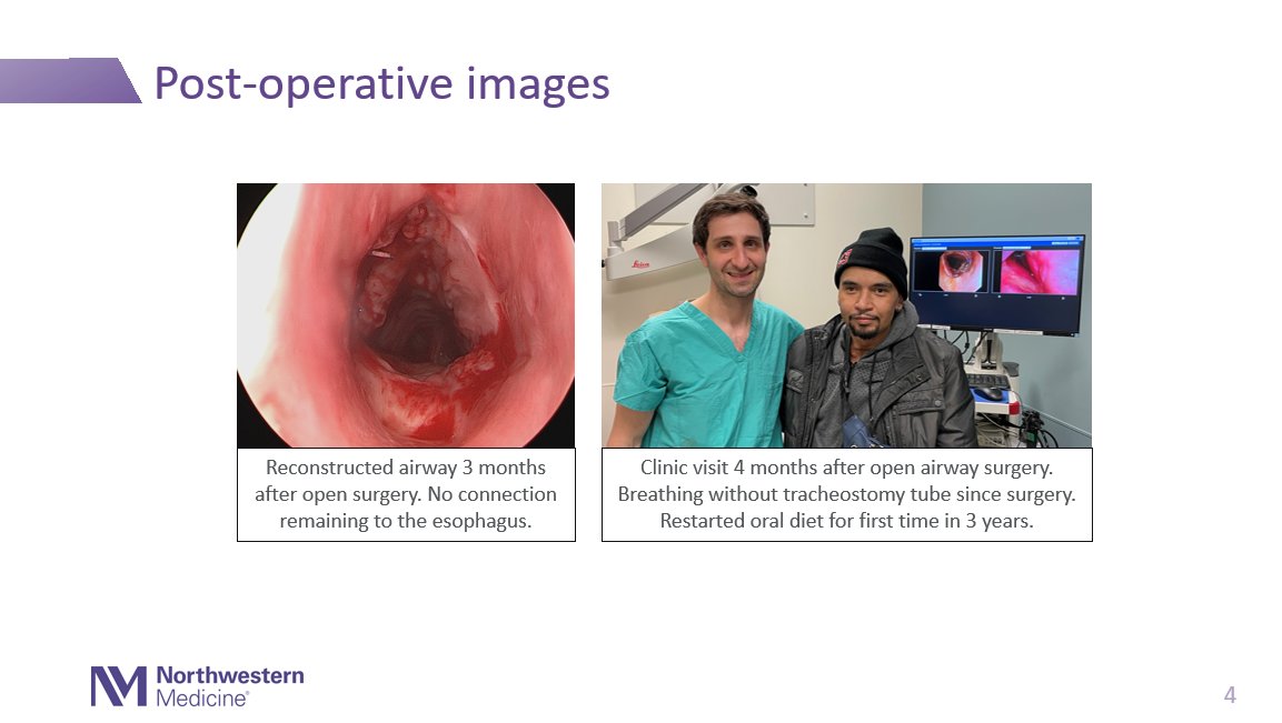 The Northwestern Medicine #ComplexAirways team of pulmonologists, thoracic surgeons and otolaryngologists worked to #reconstruct a patient's airway and a very complex #fistula to the food pipe. #MultidisciplinaryTeam