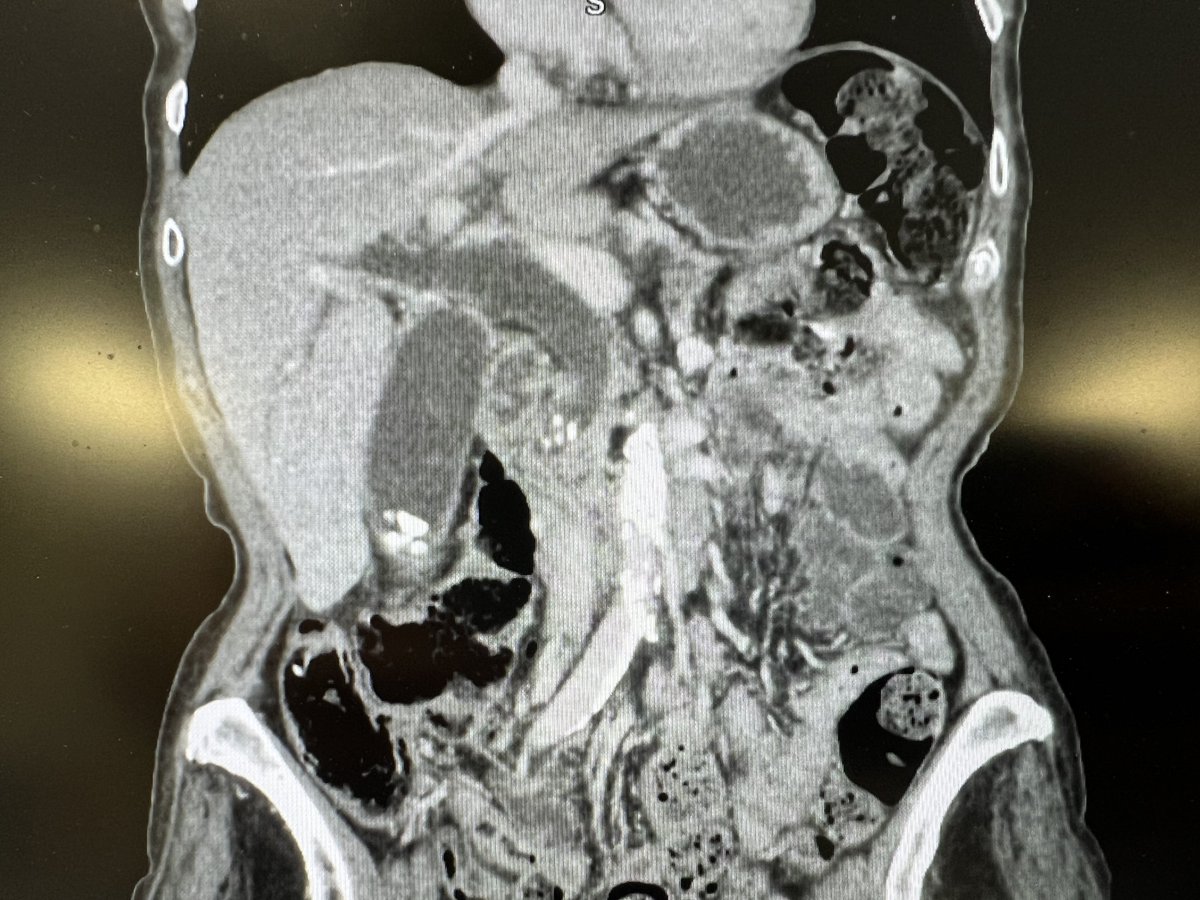 drkeithsiau's tweet photo. What is the cause of abdominal pain in this patient? #WithConsent https://t.co/JL37BCmr7X
