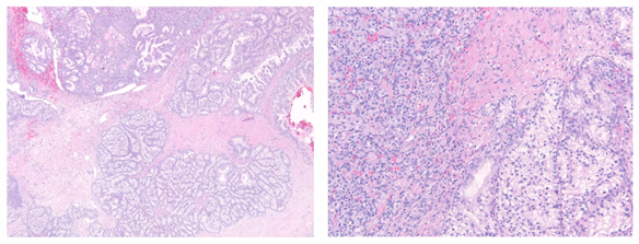 Samson W. Fine, MD (@rovingatuscap) on Twitter photo Dr. Tatjana Antic <a href="/UChicagoPath/">University of Chicago Pathology</a> presenting Histopathology & Molecular Diagnostics for Hereditary RCC #kidneycancer at <a href="/GU_Path_Society/">GU Pathology Society (GUPS)</a> Virtual Education Series #gupath HAPPENING NOW!!
<a href="/Shounak_Gupta/">Sounak Gupta</a> <a href="/drmehrarohit/">ROHIT MEHRA</a> <a href="/manjuaron/">manju aron</a> Dr. Tatjana Antic <a href="/UChicagoPath/">University of Chicago Pathology</a> presenting Histopathology & Molecular Diagnostics for Hereditary RCC #kidneycancer at <a href="/GU_Path_Society/">GU Pathology Society (GUPS)</a> Virtual Education Series #gupath HAPPENING NOW!!
<a href="/Shounak_Gupta/">Sounak Gupta</a> <a href="/drmehrarohit/">ROHIT MEHRA</a> <a href="/manjuaron/">manju aron</a>