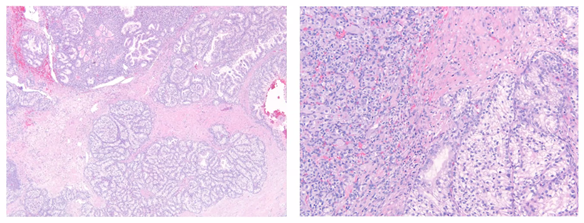 Dr. Tatjana Antic @UChicagoPath presenting Histopathology & Molecular Diagnostics for Hereditary RCC #kidneycancer at @GU_Path_Society Virtual Education Series #gupath HAPPENING NOW!! @Shounak_Gupta @drmehrarohit @manjuaron