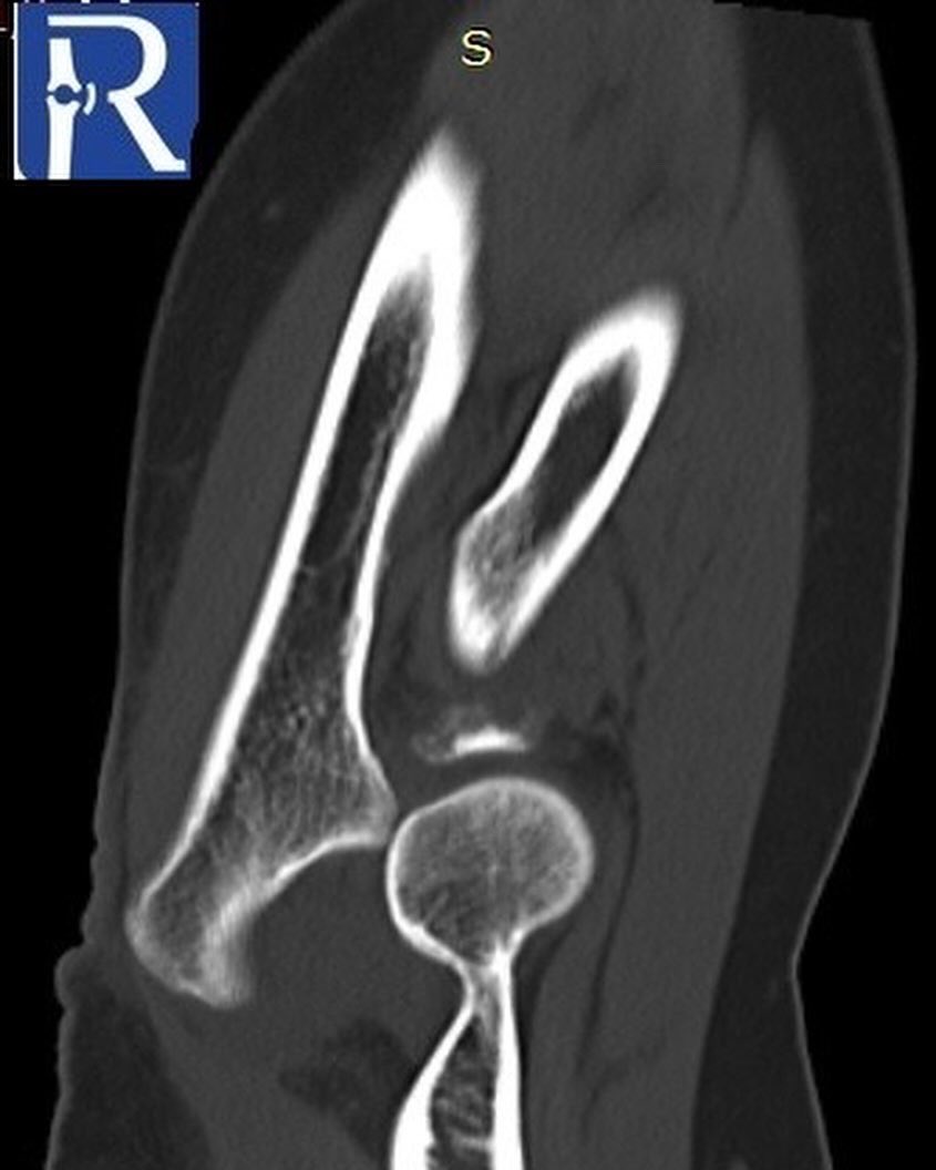 A 58-year-old woman was admitted after a fall on an outstretched hand. #radiology #mskrad #Medstudent #emergencymedicine #radtwitter #MedTwitter #radres