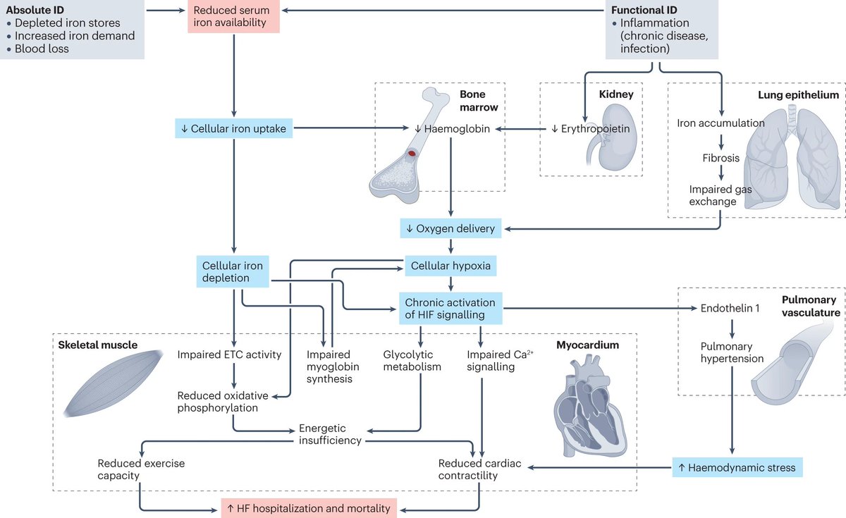 📌Iron deficiency & supplementation in #HeartFailure #IronDeficiency #HF #Review